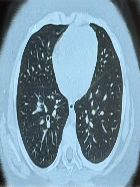 Shedding Light on Non-CF Bronchiectasis: What You Need to Know